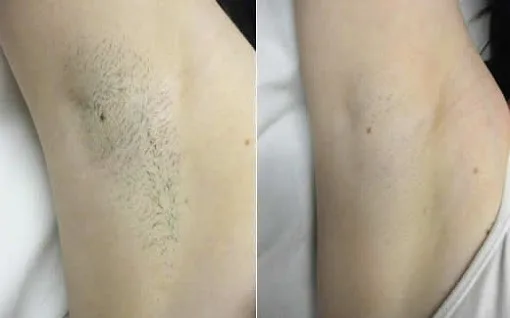 Laser Hair Removal Work Showcase 5