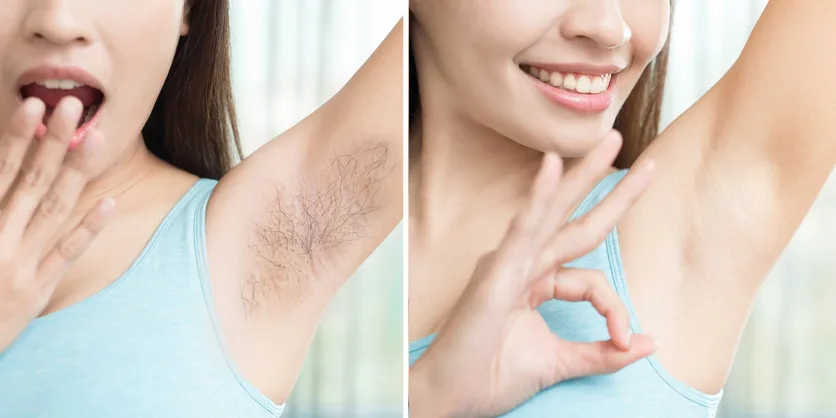 Laser Hair Removal Work Showcase 6