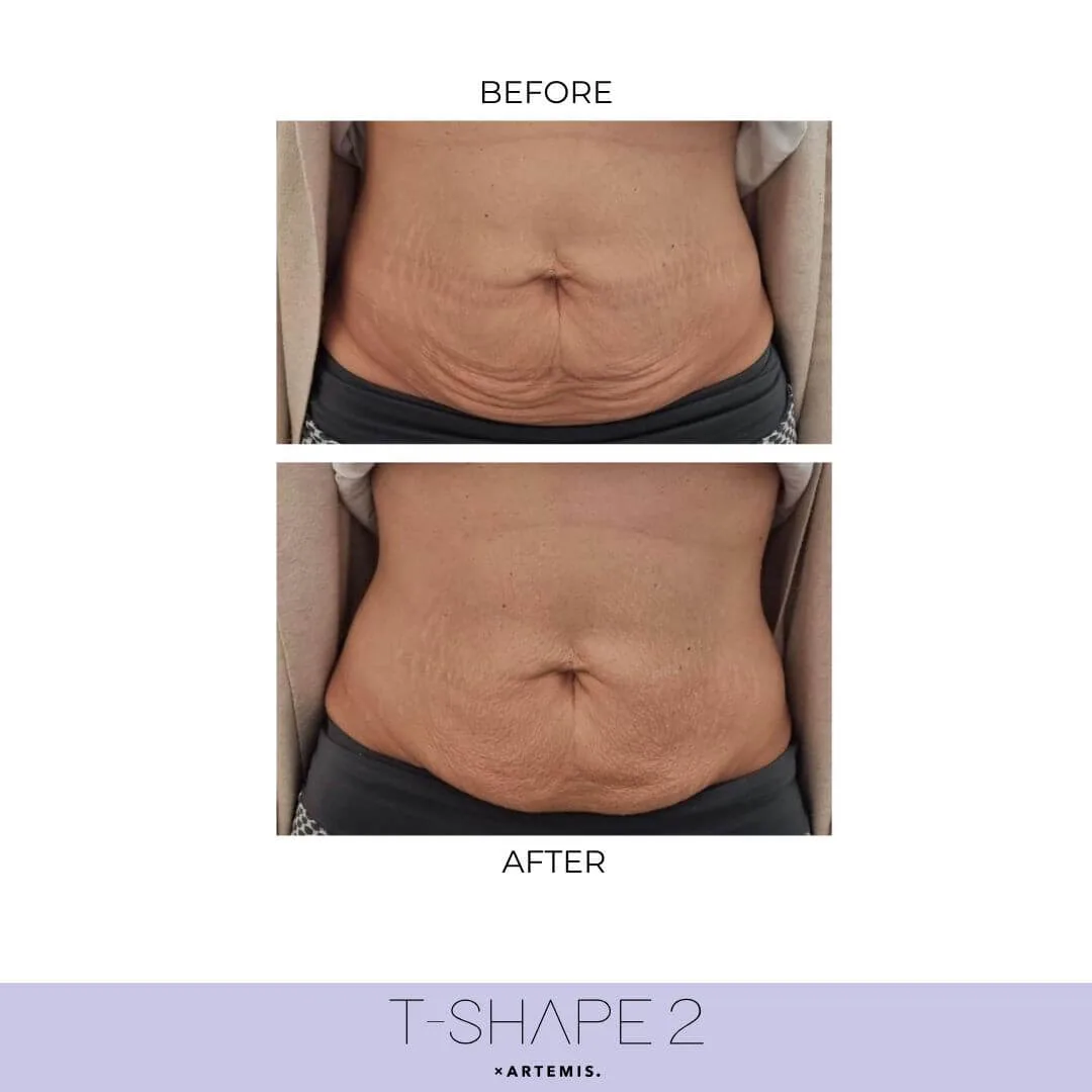 T-Shape body sculpting & skin tightening for your best contours. 🔥 #bodysculpting